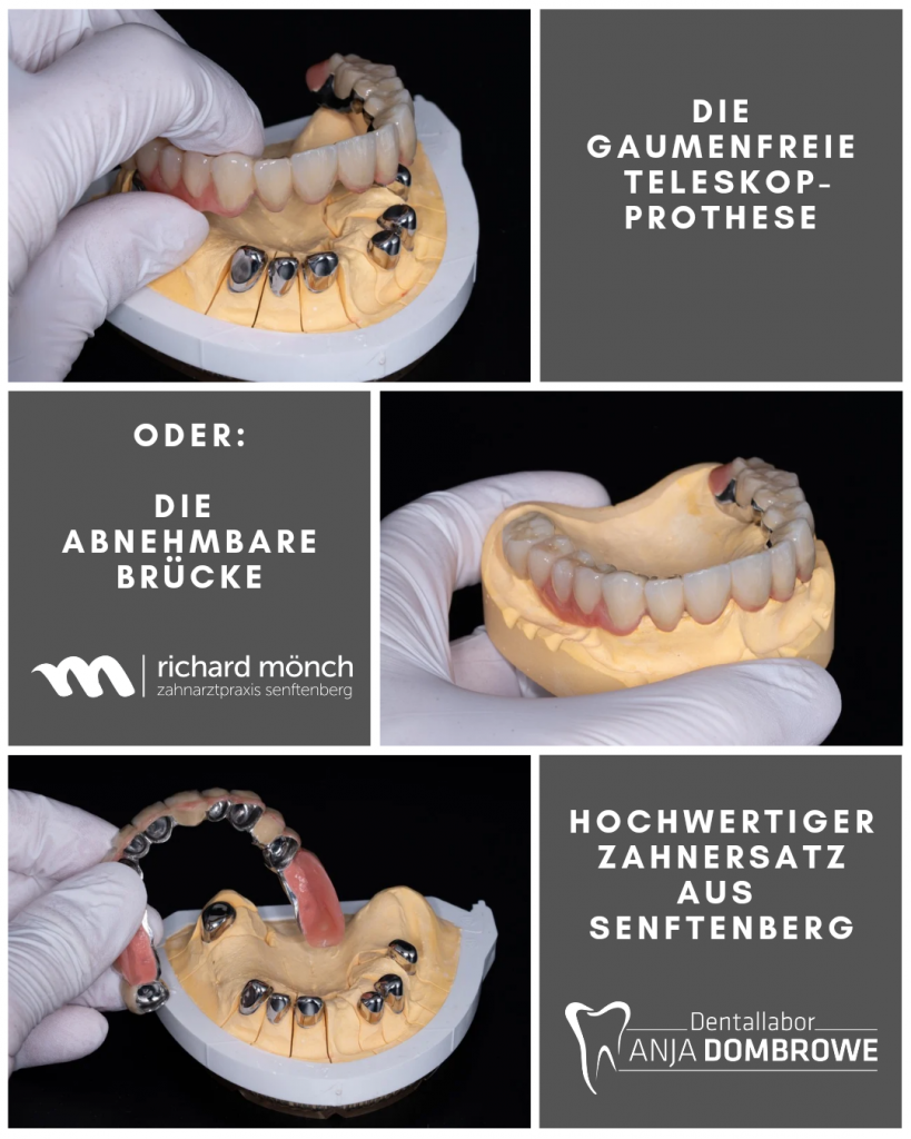 Die gaumenfreie Teleskopprothese