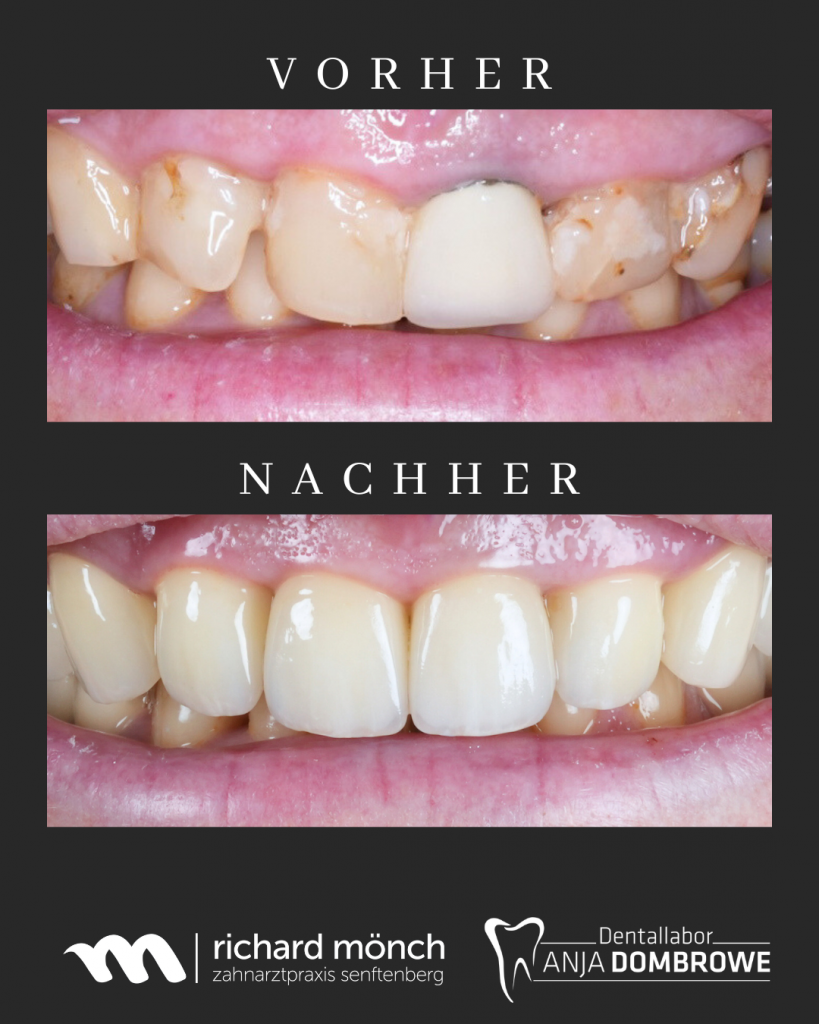 Keramikkronen_Sanierung