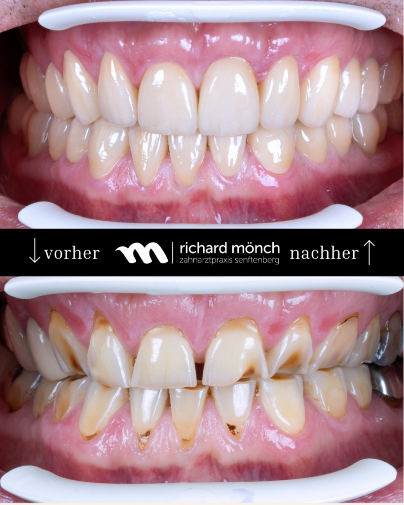 Sanierung Abrasionsgebiss